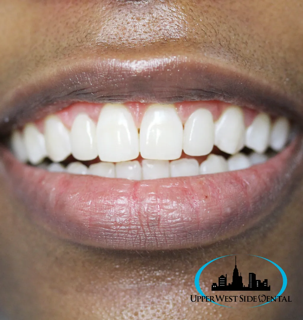 The same smile after a smile makeover — even edges and a brighter, uniform shade