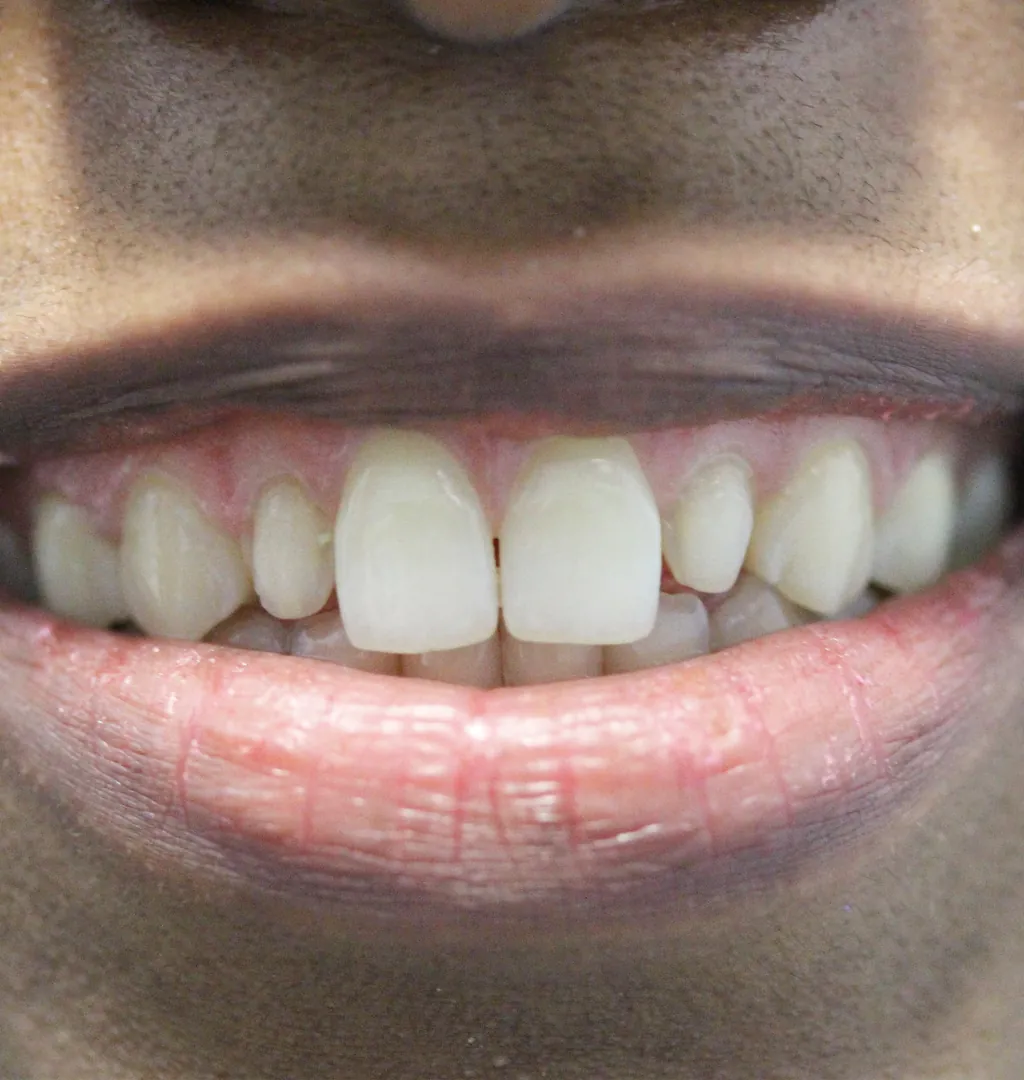 Smile before treatment with chipped, uneven front teeth